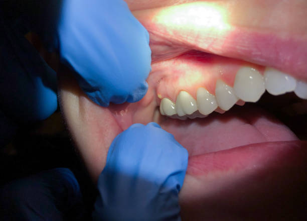 Best Emergency Denture Repair in Nappanee, IN