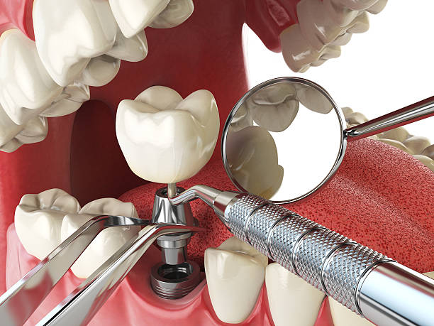 Best Lost Filling or Crown Replacement in Nappanee, IN